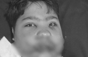 MP में फ्रिज फटा: मासूम की 108 हड्डियां टूटी, डॉक्टरों ने 5 घंटे में लौटाई जिंदगी