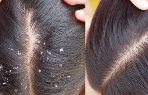 डैंड्रफ नहीं, स्कैल्प की गंभीर समस्या भी हो सकती है! तेल लगाने से पहले जान लें ये सच्चाई