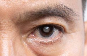 साइलेंट चोर ‘ग्लूकोमा’ से सावधान! आंखों में दिखें ये संकेत तो तुरंत कराएं जांच