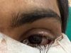 स्किन ग्राफ्टिंग से मरीज के पलक का सफल पुनर्निर्माण