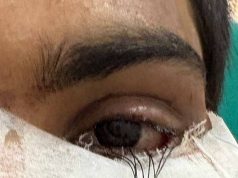स्किन ग्राफ्टिंग से मरीज के पलक का सफल पुनर्निर्माण